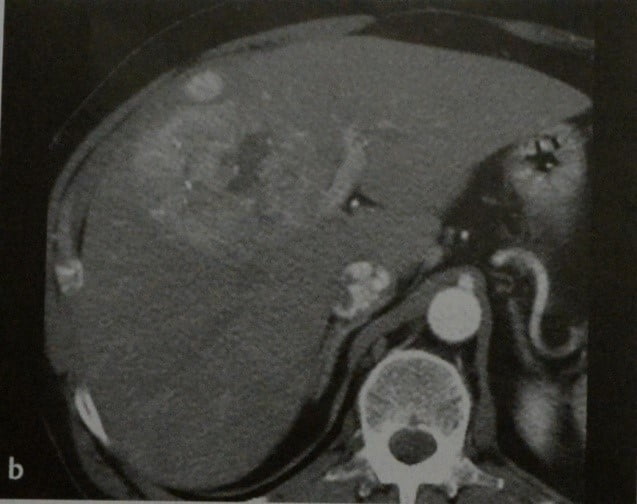Снимки МРТ и КТ. Гепатоцеллюлярная карцинома (ГЦК)
