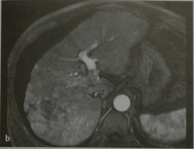 Снимки МРТ и КТ. Гепатоцеллюлярная карцинома (ГЦК)