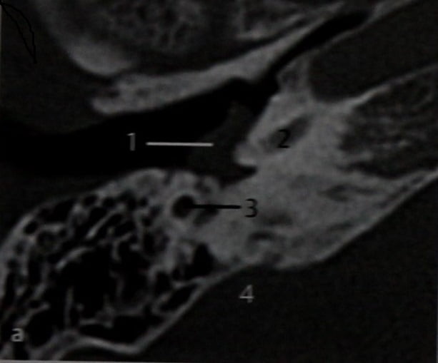 Снимки МРТ и КТ. Гломусная опухоль уха (барабанная параганглиома)